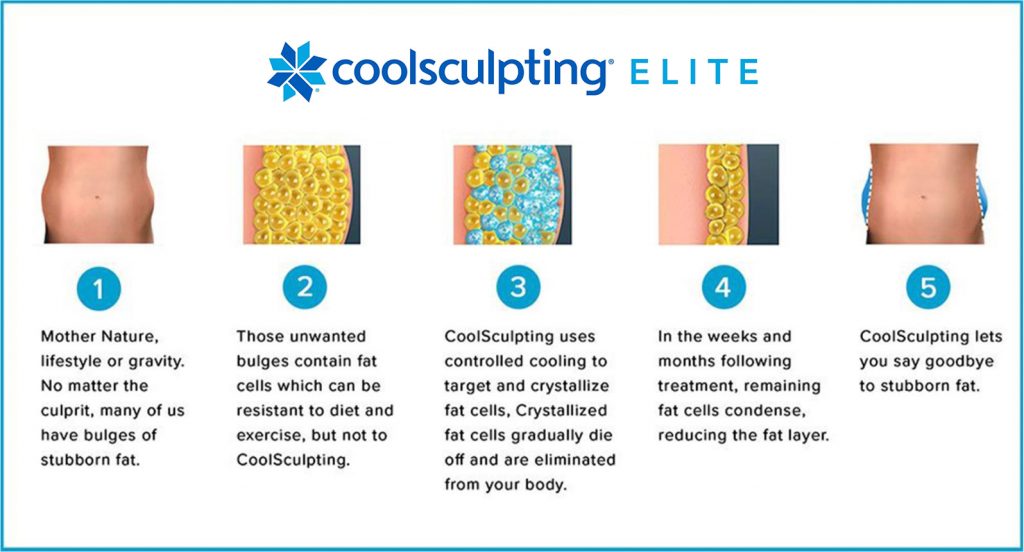 CoolSculpting Elite Melbourne Vero Beach FL White Orchid Spa