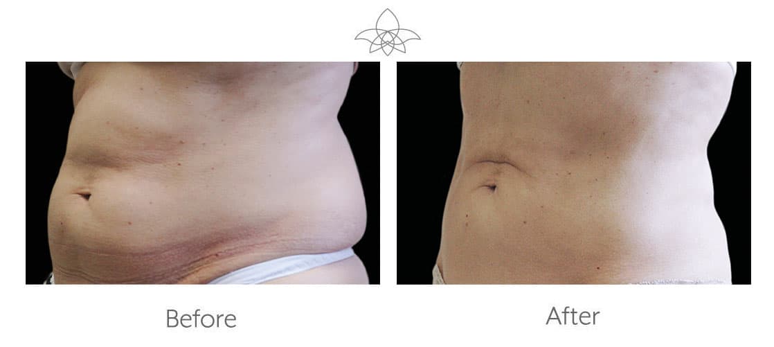 How Effective Is CoolSculpting?: Chrysolite Aesthetics : Aesthetic Medical  Spa
