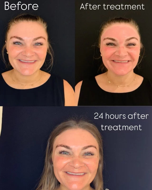 Microneedling + Exosomes = Rapid Glow-Up ✨

Swipe to see the transformation! Our client paired microneedling with exosome therapy, and just 24 hours later, their skin is already healing beautifully. Exosomes work at a cellular level to reduce inflammation, speed up recovery, and enhance collagen production—leaving skin smoother, firmer, and radiant in record time.

Why wait for results when you can glow this fast? Book your treatment today! #exosometherapy #microneedling #skinrejuvenationtreatment #glowingskin